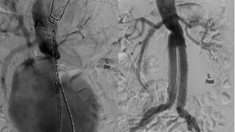 Endovascular Aortic Aneurysm Repair - EVAR