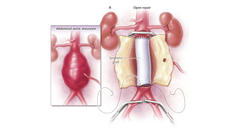 Open Surgery Repair AAA